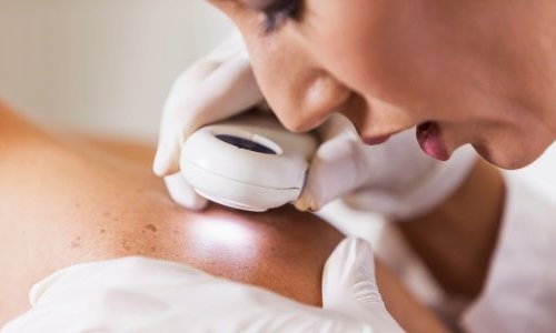 Sweden sees skin cancer decline in under-50s for 1st time: study